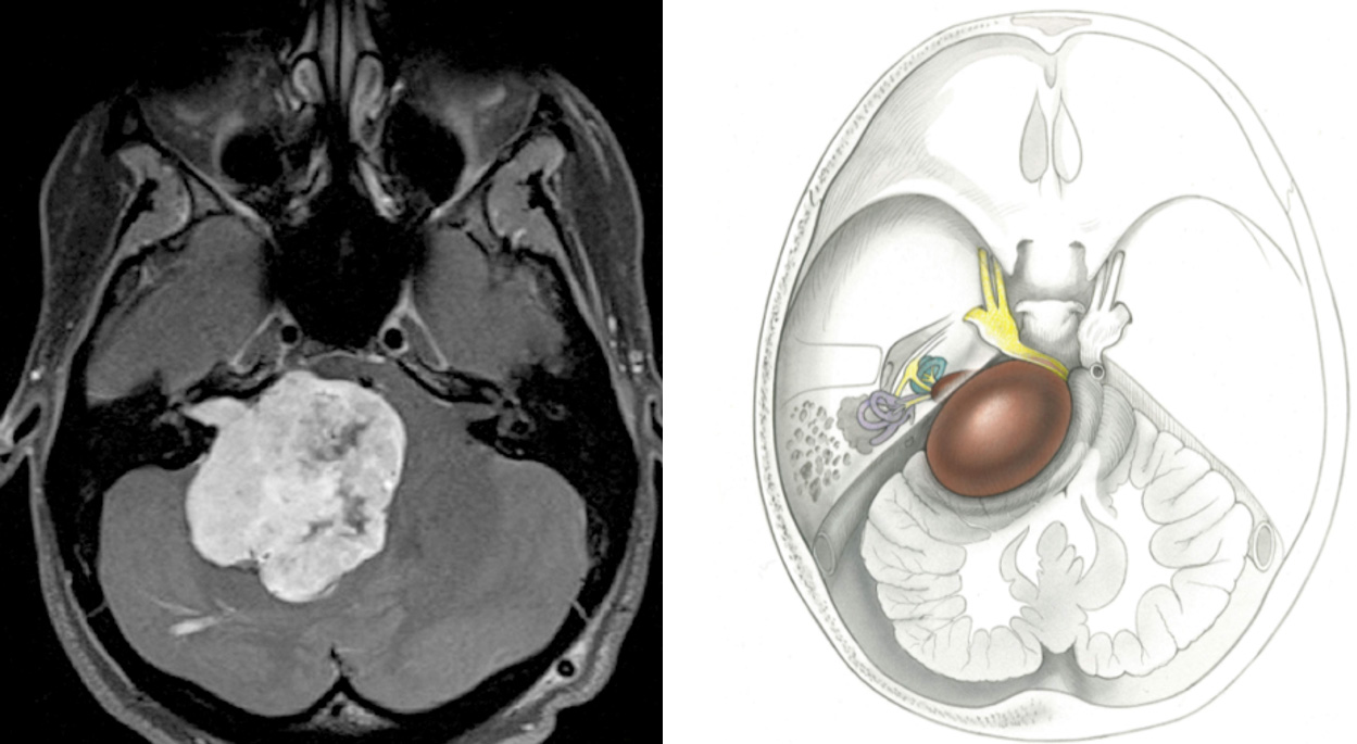 Schwannoma Expert Surgeon Aaron Cohen Gadol MD Schwannoma Expert Surgeon Aaron Cohen Gadol MD