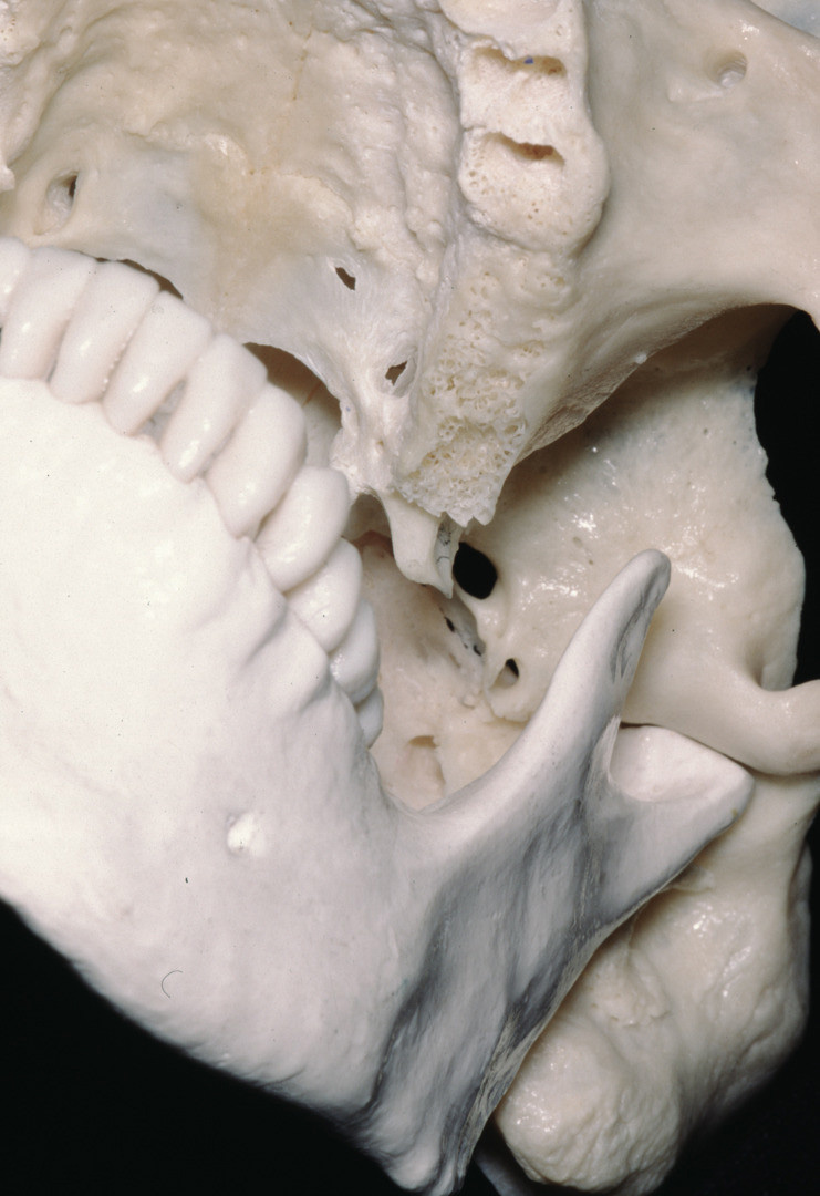 Inferior Oblique View Of Bones Of The Oral Cavity | Neuroanatomy | The  Neurosurgical Atlas Inferior Oblique View Of Bones Of The Oral Cavity | Neuroanatomy | The  Neurosurgical Atlas