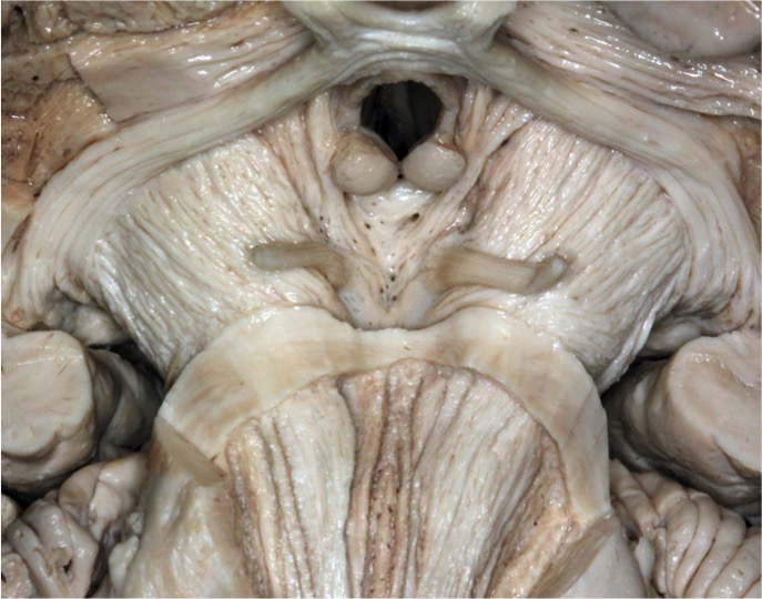 Fiber Dissection of the Upper Brainstem | Neuroanatomy | The