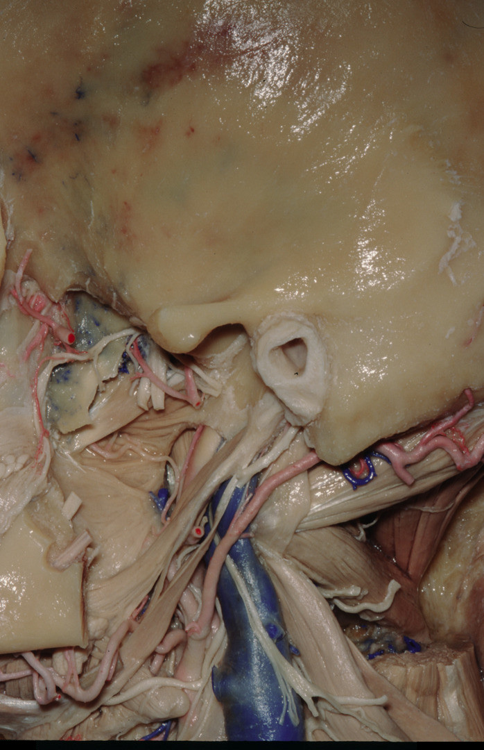 Left Lateral Deep Neck, Suboccipital, and Pharyngeal Wall Dissection