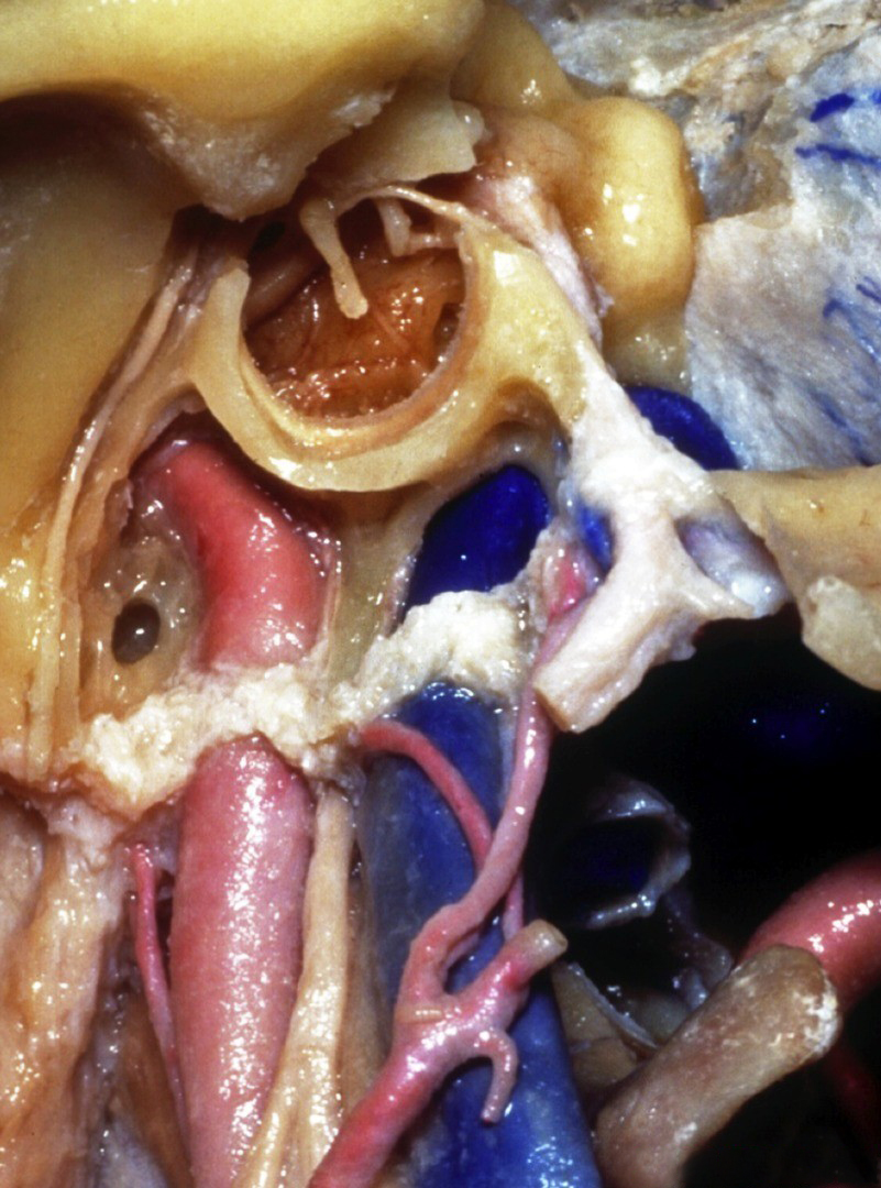Caudal Left Tympanic and Mastoid Regions after Temporal Drilling