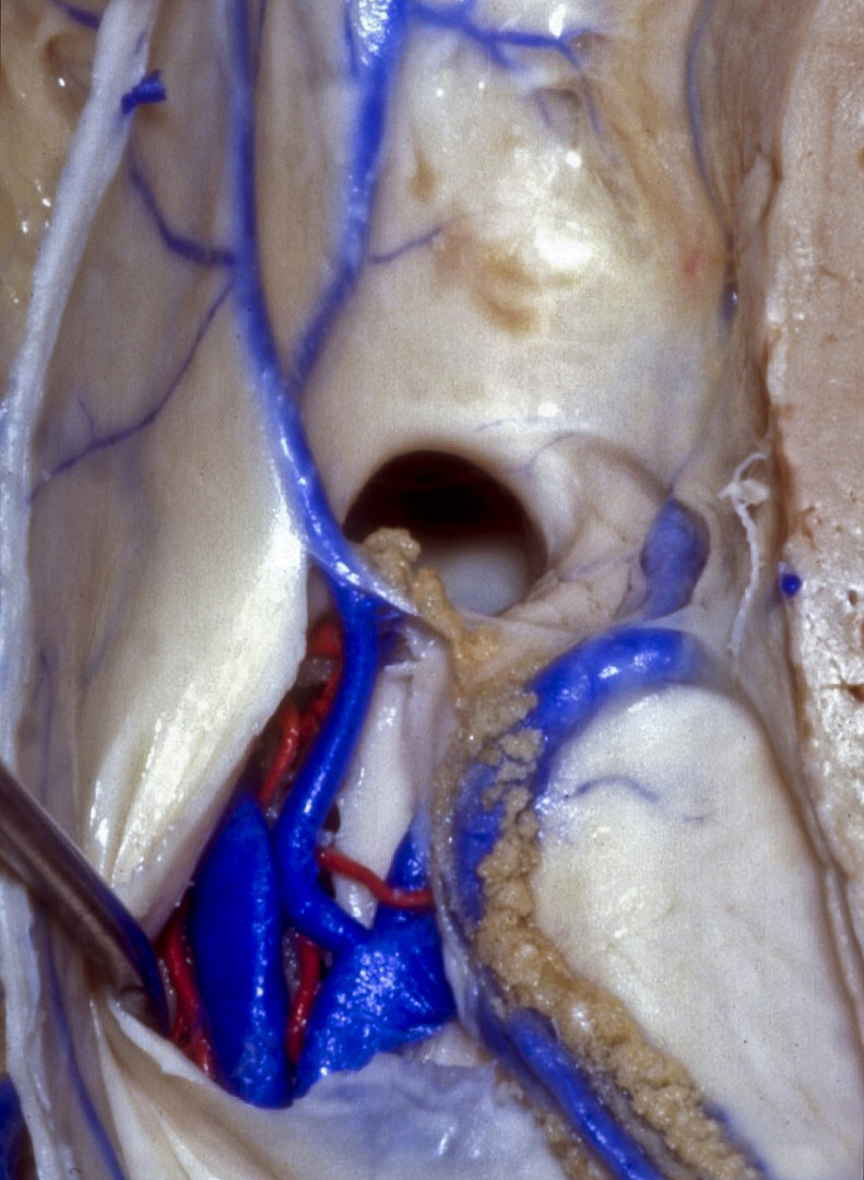 Retraction of Fornix to Demonstrate Internal Cerebral Veins