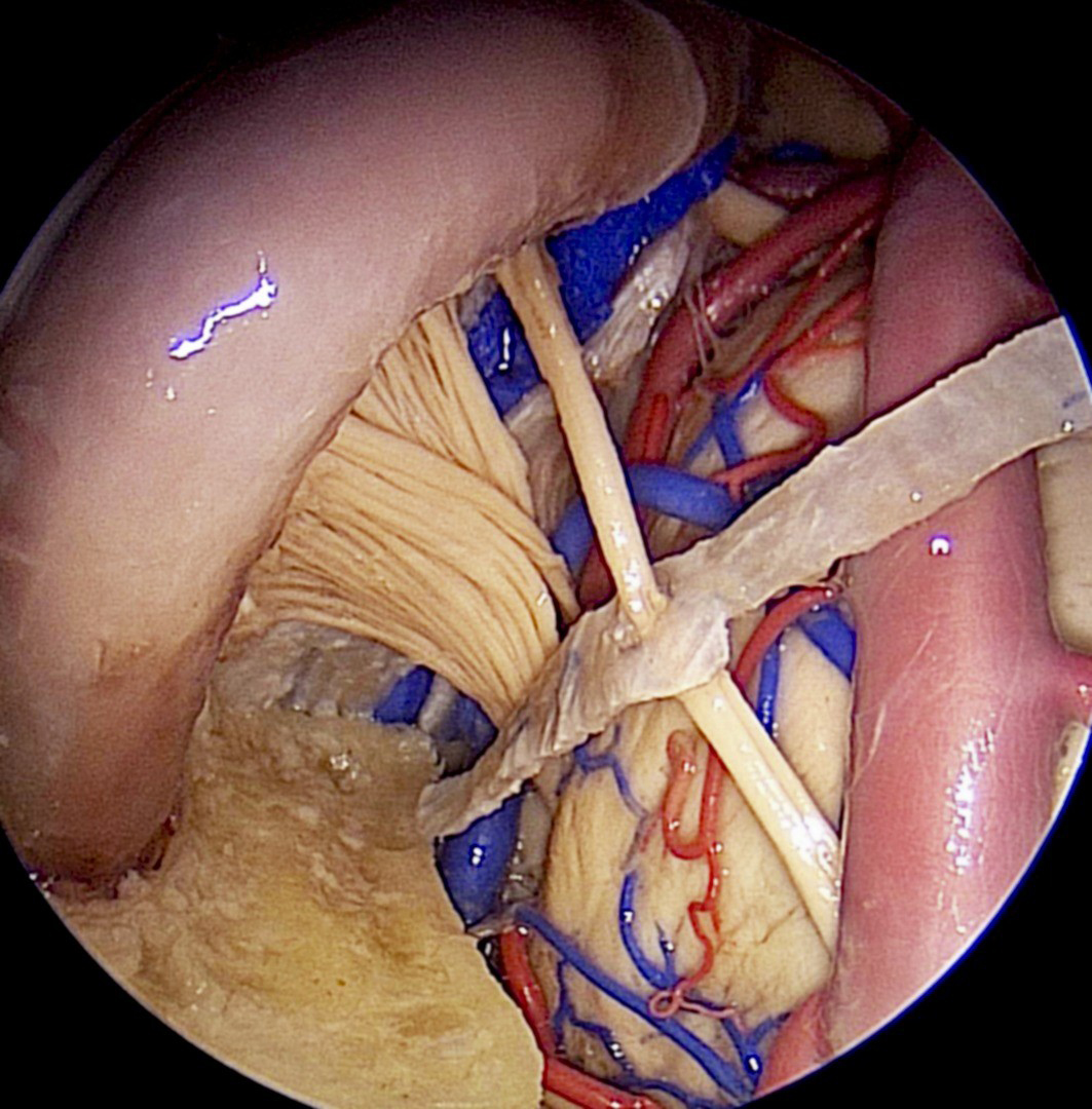 Endonasal Perspective of Trigeminal Nerve | Neuroanatomy | The