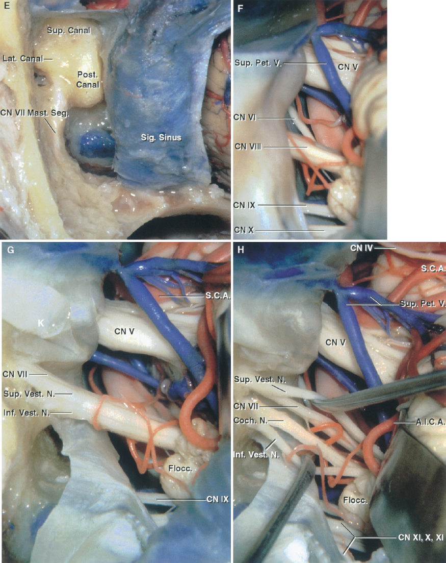 Comparison of the Retrosigmoid Approach and the Minimal Mastoidectomy