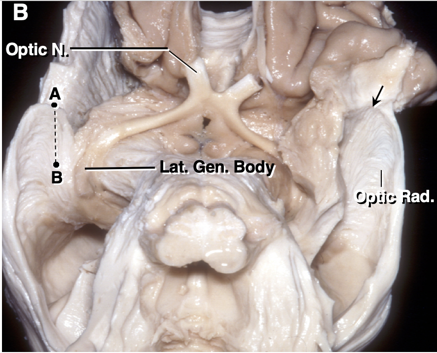 Optic Radiations and the Visual Pathway | Neuroanatomy | The