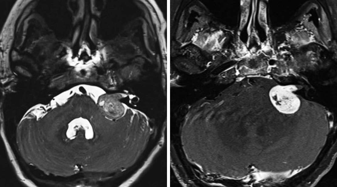 Radiology Vestibular Schwannoma At Jeff Updike Blog Radiology Vestibular Schwannoma At Jeff Updike Blog