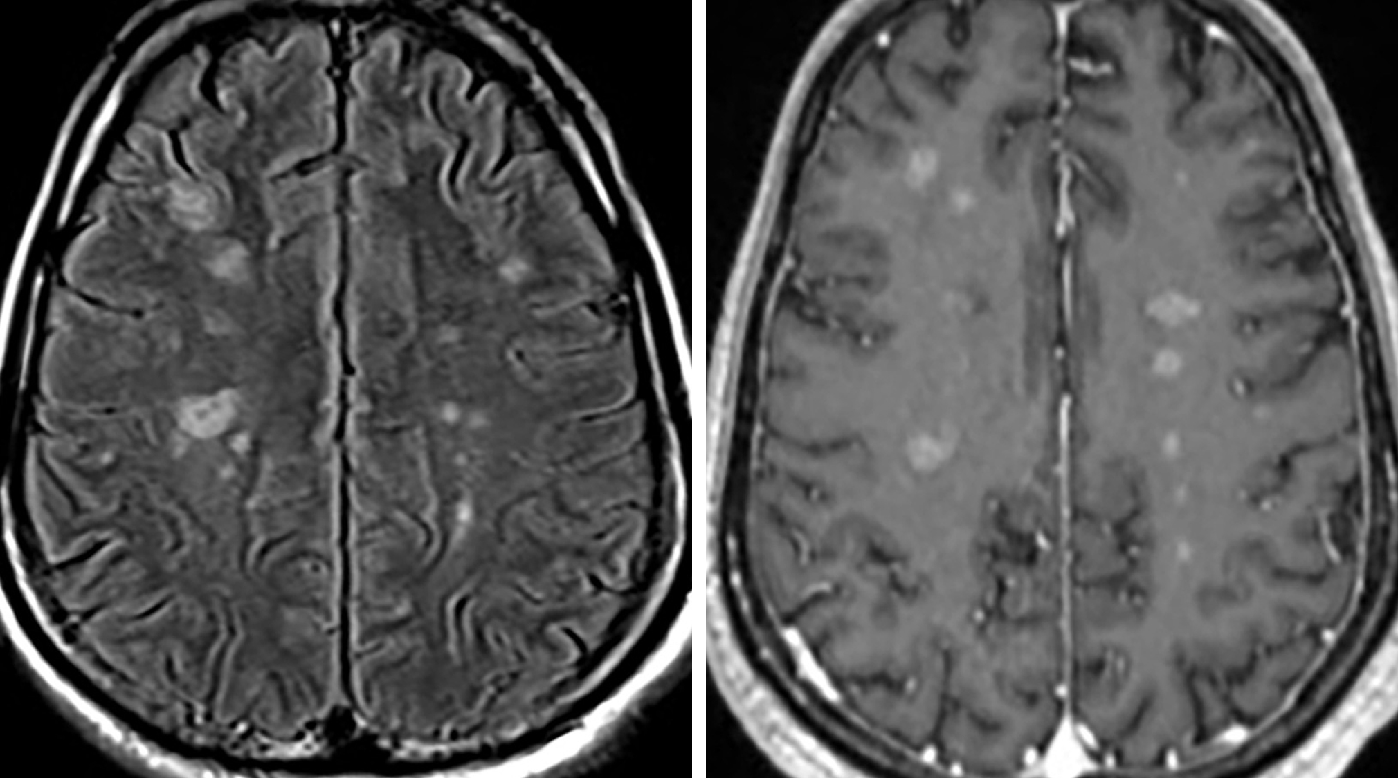 Neurosarcoidosis The Neurosurgical Atlas