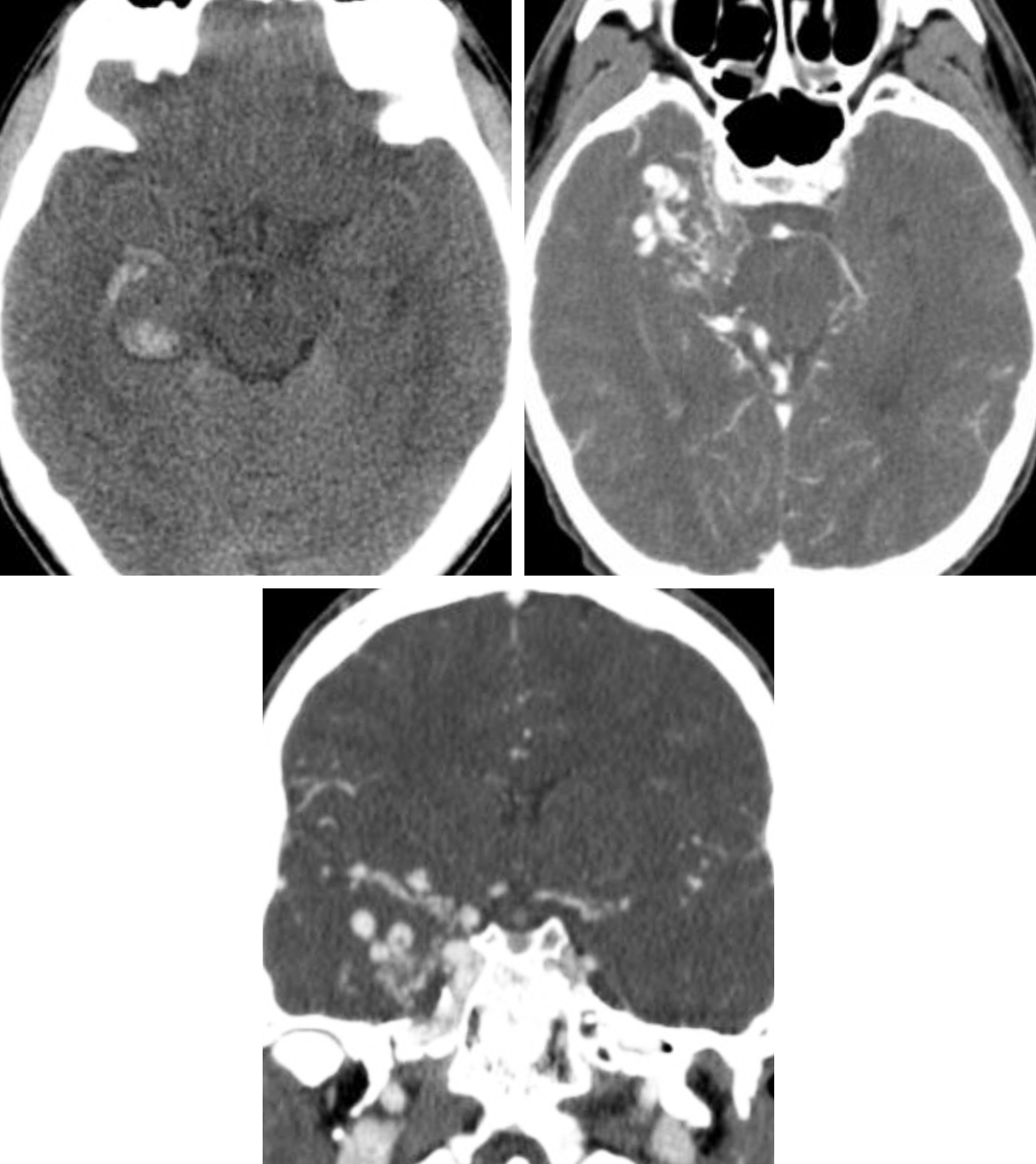 Arteriovenous Malformation The Neurosurgical Atlas