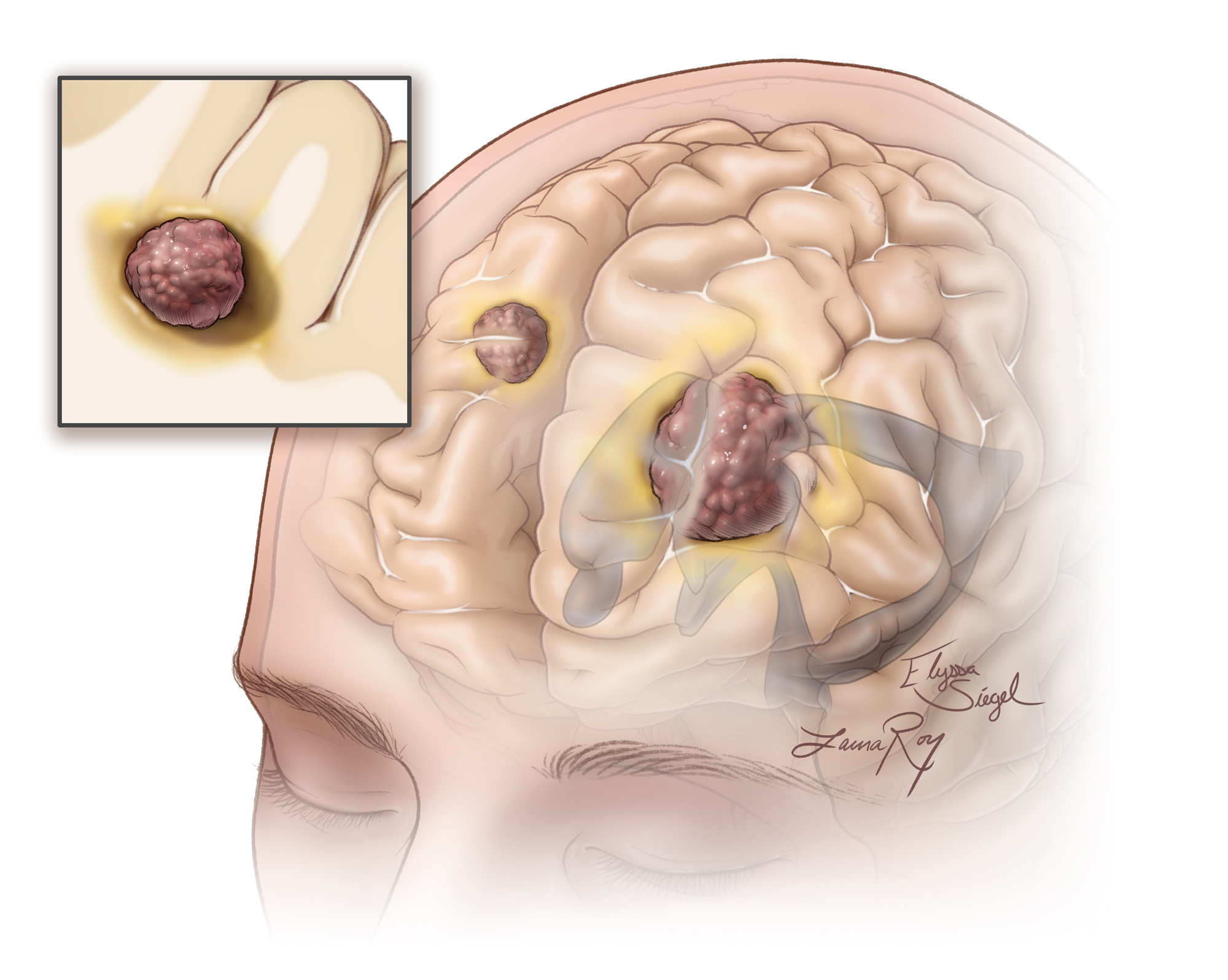 Does Thyroid Cancer Spread To Brain