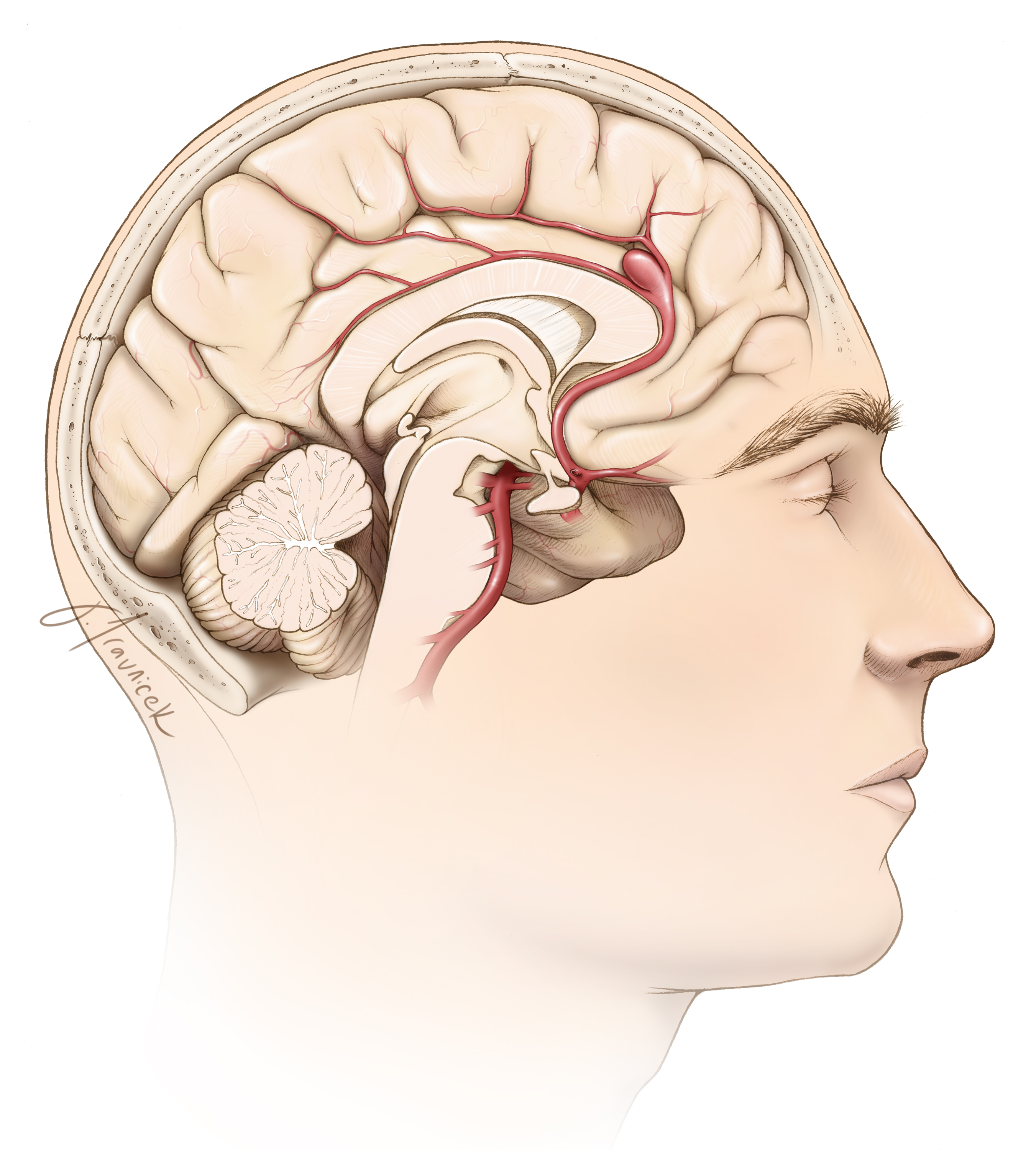 Brain Aneurysms General Information The Neurosurgical Atlas
